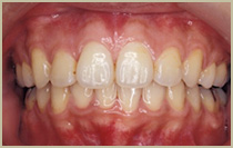 出っ歯（上顎前突）症例・治療後