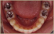 出っ歯（上顎前突）症例・治療後