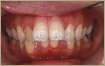 出っ歯（上顎前突）症例・治療前