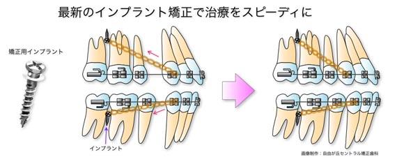 最新のインプラント矯正で治療をスピーディに