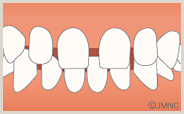 空隙歯列