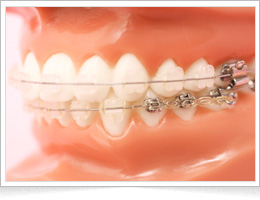 セラミックブラケット