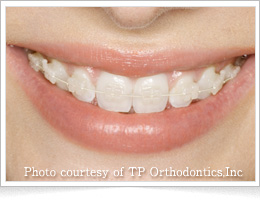 セラミックブラケット(インビュー)