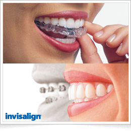 マウスピース型カスタムメイド矯正歯科装置(インビザライン)