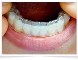 マウスピース型カスタムメイド矯正歯科装置(クリアアライナー)