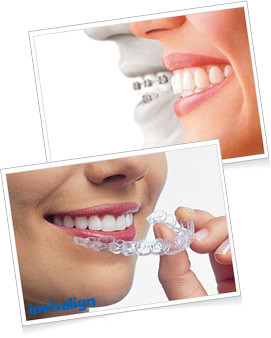 インビザライン
