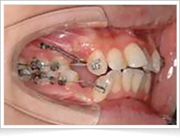 インプラント矯正の症例写真