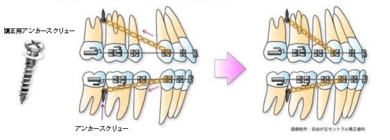 インプラント矯正で治療